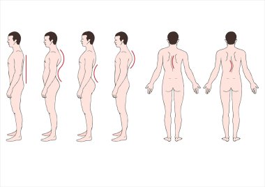Deformstion of the spine  clipart